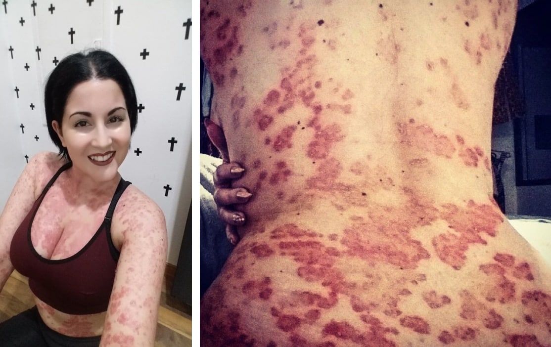 Malgré son psoriasis, elle veut devenir mannequin