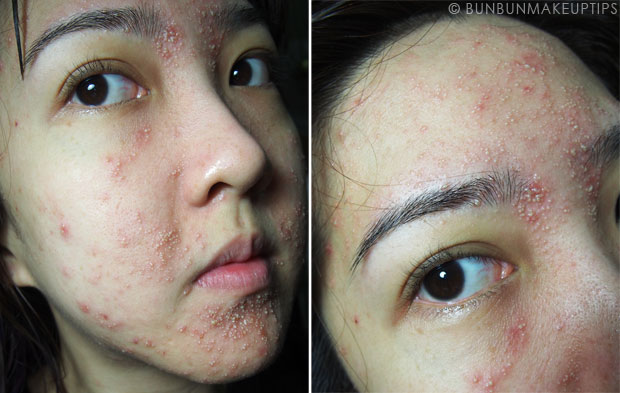 My-Skin-Ravaged-Allergic-Reaction-After-Facial-Experience_day-4-night_3