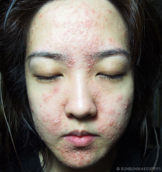 My-Skin-Ravaged-Allergic-Reaction-After-Facial-Experience_day-4-night_5