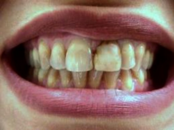 Ne pas se brosser les dents tous les jours