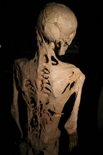 Fibrodysplasia_ossificans_progressiva