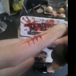 blessure