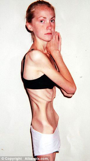 harriet-smith-anorexie