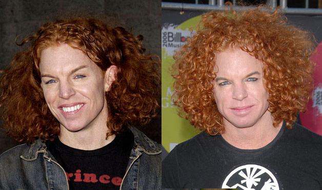 09-Botch-Plastic-Surgeries-Carrot-Top-lifestyle-1