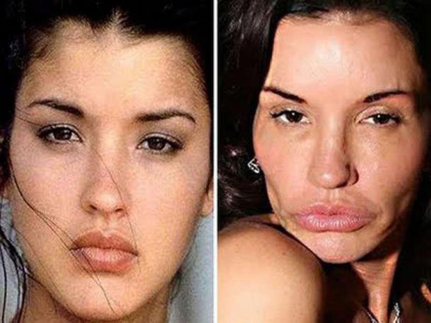 plastic_surgery_fails_7