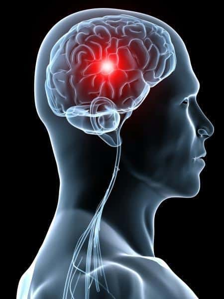 AVC-schema-cerveau