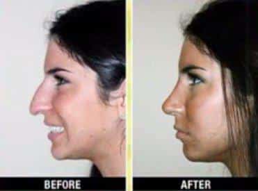 Jenna Selter, la plus connue d'Instagram, et qui a subi une rhinoplastie à 15 ans