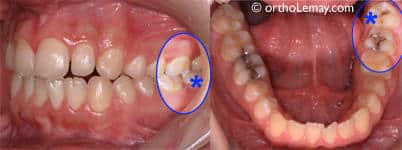 dent-de-sagesse-carie-occlusion-dentaire-orthodontie-113203-SA17