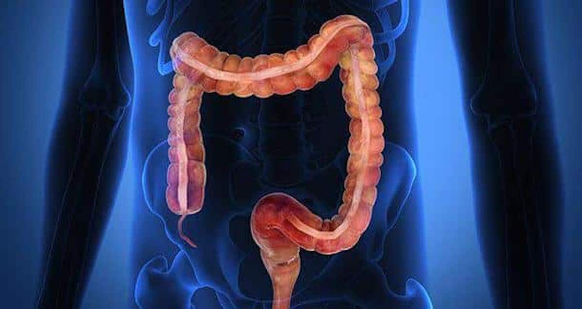 Incroyable ! Notre côlon peut contenir jusqu'à 5 kilos de déchets qui