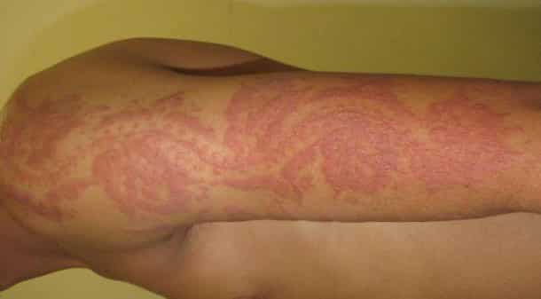 Voilà à quoi vous vous exposez en risquant un tatouage au henné...