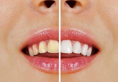dents