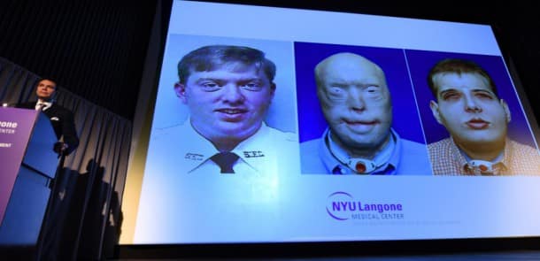 Dr. Eduardo Rodriguez, MD, DDS, chair, Hansjorg Wyss Dept. Plastic Surgery, NYU Langone, holds a press conference at NYU Langone Medical Center in New York City November 16, 2015 to announce the successful completion of the most extensive face transplant to date. Dr. Rodriguez led the surgery following a year of preparation on 41-year-old Patrick Hardison(on screen), a first responder horribly disfigured in 2001. More than 100 doctors, nurses, technical and support staff took part in the 26-hour operation, conducted in mid-August at the NYU Langone Medical Center, the center announced. Hardison, from Senatobia, Mississippi who suffered extensive facial burns as a volunteer firefighter, just days before the September 11, 2001 attacks. Hardison was severely disfigured when the roof of a burning home collapsed on top of him during a rescue search, losing his eyelids, ears, lips, most of his nose, hair and eyebrows.AFP PHOTO / TIMOTHY A. CLARY