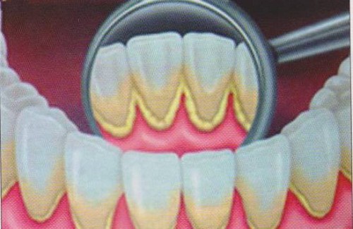 Tartre-dentaire-500x325