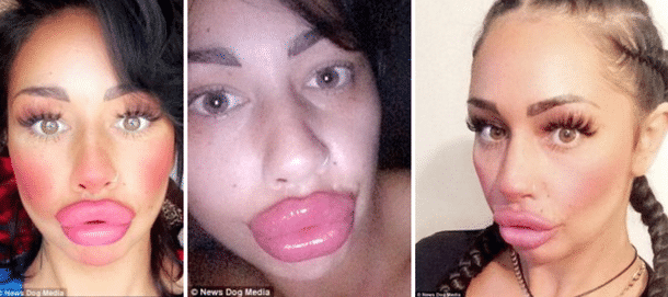 Elle se fait injecter 6.5 ml de botox dans les lèvres, découvrez le ...