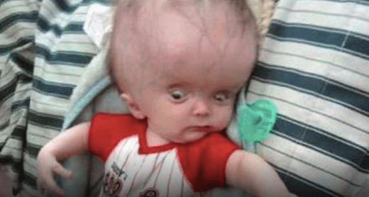 Lorsqu Il Est Ne Son Bebe Avait Une Enorme Tete Les Medecins Le Croyaient Condamne Regardez Ce Qu Il Est Devenu Aujourd Hui