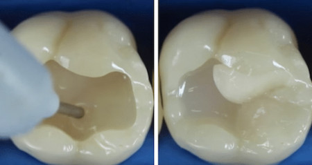 caries