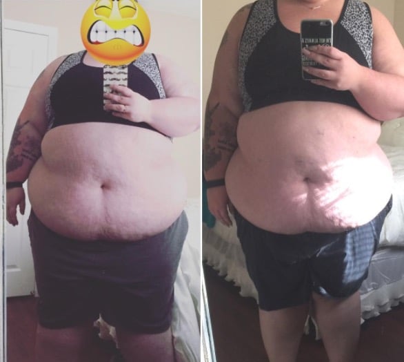 obesite morbide obesite morbide