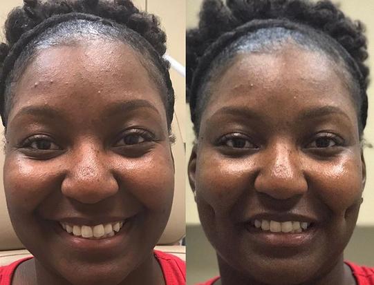 fossettes tendance beaute