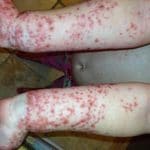 staphylocoque jeu gonflable