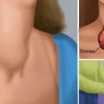 troubles de la thyroide