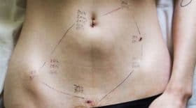 endometriose