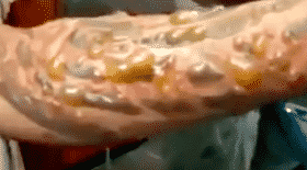 tatouage, infection