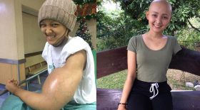 bras gonflé cancer amputation bras de popeye