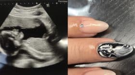 manucure echographie