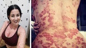 mannequin montre son psoriasis