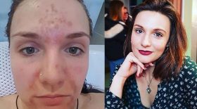 toc gratter la peau du visage dermatillomanie