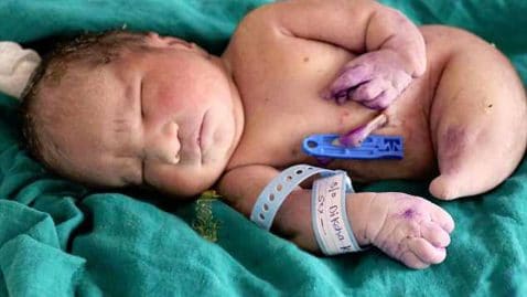 bébé sirène queue de poisson jambes fusionnées