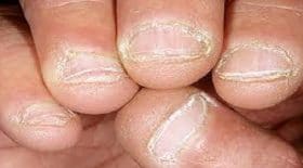 se ronger les ongles
