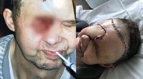 trou dans le visage cancer de l'œil migraine