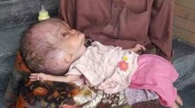 bébé tête gonflée hydrocéphalie
