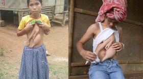 fille vit avec le bras de sa soeur jumelle parasite