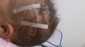 césarienne : la tête d'un bébé scalpé par un médecin