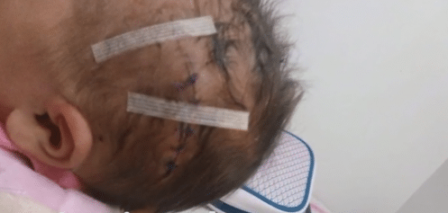 césarienne : la tête d'un bébé scalpé par un médecin