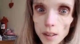 Kristina-Karyagina-médecin-anorexique