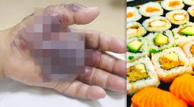 bactérie sushis main amputée