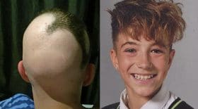 alopécie tatouage cheveux tricopigmentation