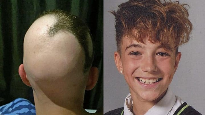 Devenu chauve à 16 ans, il se fait tatouer des faux cheveux pour