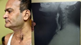 dentier avalé œsophage troué
