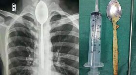 cuiller coincée dans l'œsophage
