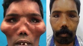 maladie du visage de lion opération os