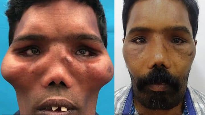 maladie du visage de lion opération os