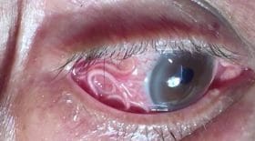 ver filaire oeil opération médecin
