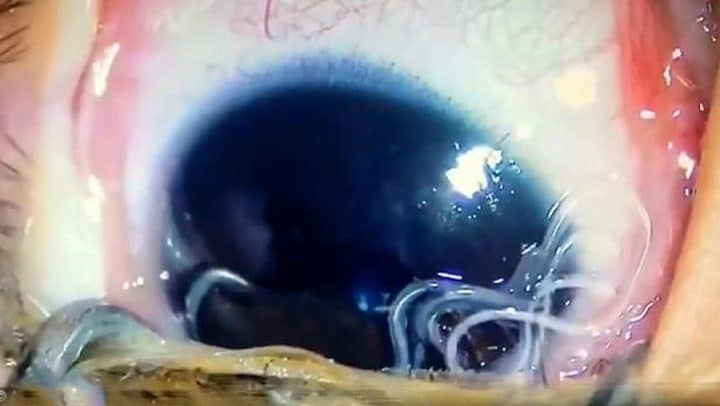 nématodes dans les yeux d'un bébé