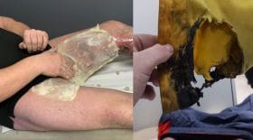 cigarette électronique explose dans sa poche