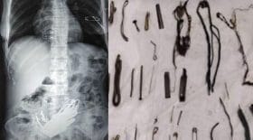 acuphagie objets métalliques estomac pica