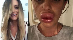 soirée Botox injections dans les lèvres